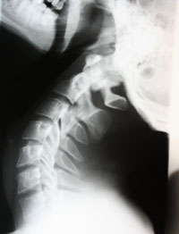En whiplashskada kan vanligtvis behandlas effektivt av en kiropraktor